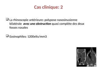 Cas clinique: 2
 La rhinoscopie antérieure: polypose nasosinusienne
bilatérale avec une obstruction quasi complète des deux
fosses nasales
 Eosinophiles: 1200elts/mm3
 