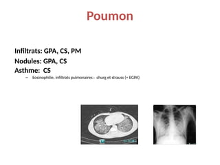 Poumon
Infiltrats: GPA, CS, PM
Nodules: GPA, CS
Asthme: CS
– Eosinophilie, infiltrats pulmonaires : churg et strauss (= EGPA)
 