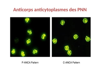 Anticorps anticytoplasmes des PNN
 