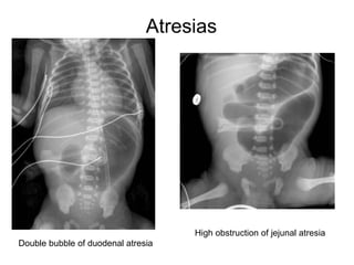 Atresias




                                    High obstruction of jejunal atresia
Double bubble of duodenal atresia
 