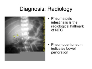 Diagnosis: Radiology
          • Pneumatosis
            intestinalis is the
            radiological hallmark
            of NEC



          • Pneumoperitoneum
            indicates bowel
            perforation
 