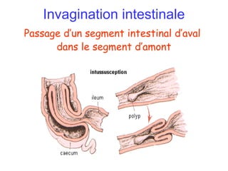 Invagination intestinale
Passage d’un segment intestinal d’aval
      dans le segment d’amont
 