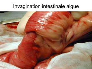 Invagination intestinale aigue
 