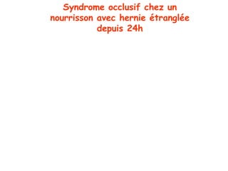 Syndrome occlusif chez un
nourrisson avec hernie étranglée
           depuis 24h
 