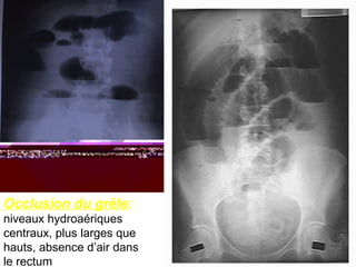 Occlusion du grêle:
niveaux hydroaériques
centraux, plus larges que
hauts, absence d’air dans
le rectum
 