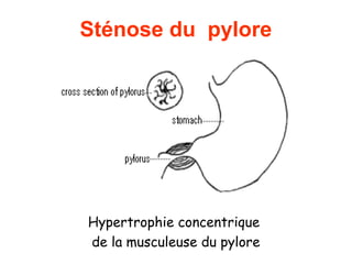 Sténose du pylore




Hypertrophie concentrique
de la musculeuse du pylore
 