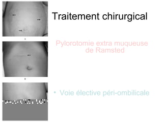 Traitement chirurgical

Pylorotomie extra muqueuse
         de Ramsted


• Voie historique sous costale
  droite
• Voie élective péri-ombilicale
• Chirurgie laparoscopique
 