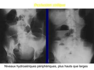 Occlusion colique




Niveaux hydroaériques périphériques, plus hauts que larges
 