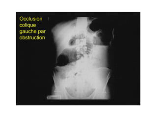 Occlusion
colique
gauche par
obstruction
 