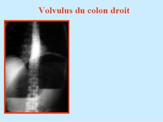 Les vomissements de l’enfant