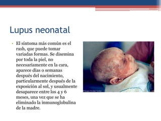 Lupus neonatal
• El síntoma más común es el
rash, que puede tomar
variadas formas. Se disemina
por toda la piel, no
necesariamente en la cara,
aparece días o semanas
después del nacimiento,
particularmente después de la
exposición al sol, y usualmente
desaparece entre los 4 y 6
meses, una vez que se ha
eliminado la inmunoglobulina
de la madre.

 