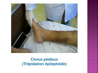 Clonus pédieux
(Trépidation épileptoïde)

 