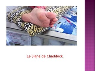 Le Signe de Chaddock

 