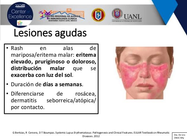 Lupus Eritematoso Sistemico Y Sindrome Antifosfolipido