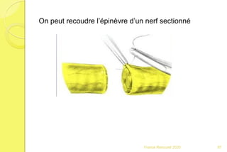 Franck Rencurel 2020 97
On peut recoudre l’épinèvre d’un nerf sectionné
 