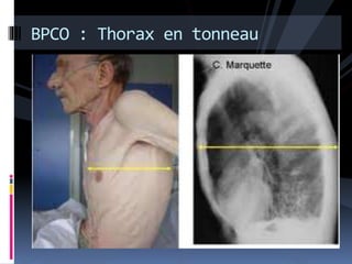 BPCO : Thorax en tonneau 
 