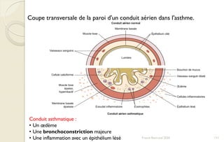 Coupe transversale de la paroi d'un conduit aérien dans l'asthme.
Conduit asthmatique :
• Un œdème
• Une bronchoconstriction majeure
• Une inflammation avec un épithélium lésé 111Franck Rencurel 2020
 