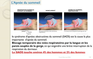 le syndrome d'apnées obstructives du sommeil (SAOS) est la cause la plus
importante d’apnée du sommeil.
Blocage temporaire des voies respiratoires par la langue et les
parois souples de la gorge, ce qui engendre une brève interruption de la
respiration du dormeur.
Le SAOS touche environ 4% des hommes et 2% des femmes
L’Apnée du sommeil
133Franck Rencurel 2020
 