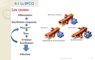 Franck Rencurel 2020 95
II-1 La BPCO
Les causes
Inflammation
Scarification muqueuse
Mucus++
Toux
Irritation
Scarification
Infections
 