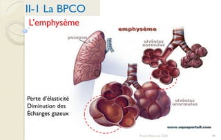 98Franck Rencurel 2020
II-1 La BPCO
L’emphysème
Perte d’élasticité
Diminution des
Échanges gazeux
 