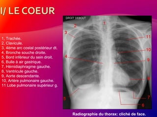 1, Trachée.
2, Clavicule.
3, 4ème arc costal postérieur dt.
4, Bronche souche droite.
5, Bord inférieur du sein droit.
6, Bulle à air gastrique.
7, Hémidiaphragme gauche.
8, Ventricule gauche.
9, Aorte descendante.
10, Artère pulmonaire gauche.
11 Lobe pulmonaire supérieur g.
Radiographie du thorax: cliché de face.
 