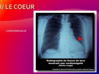 CARDIOMEGALIE
 