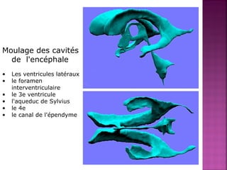 Moulage des cavités 
de l'encéphale 
• Les ventricules latéraux 
• le foramen 
interventriculaire 
• le 3e ventricule 
• l'aqueduc de Sylvius 
• le 4e 
• le canal de l'épendyme 
 