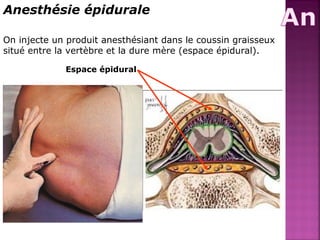 Anesthésie épidurale 
On injecte un produit anesthésiant dans le coussin graisseux 
situé entre la vertèbre et la dure mère (espace épidural). 
Espace épidural 
 