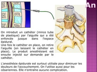 On introduit un cathéter (mince tube 
de plastique) par l'aiguille qui a été 
enfoncée jusque dans l'espace 
épidural. 
Une fois le cathéter en place, on retire 
l'aiguille (en laissant le cathéter en 
place). Le produit anesthésiant est 
ensuite injecté sur demande par le 
cathéter. 
L'anesthésie épidurale est surtout utilisée pour diminuer les 
douleurs de l'accouchement. On l'utilise aussi pour les 
césariennes. Elle n'entraîne aucune complication. 
 