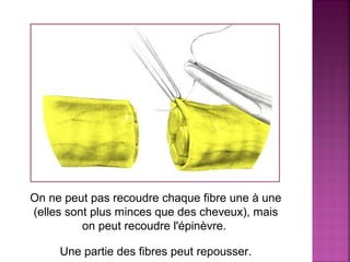 On ne peut pas recoudre chaque fibre une à une 
(elles sont plus minces que des cheveux), mais 
on peut recoudre l'épinèvre. 
Une partie des fibres peut repousser. 
 