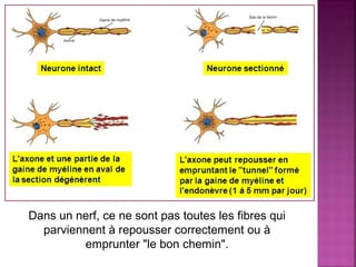 Dans un nerf, ce ne sont pas toutes les fibres qui 
parviennent à repousser correctement ou à 
emprunter "le bon chemin". 
 