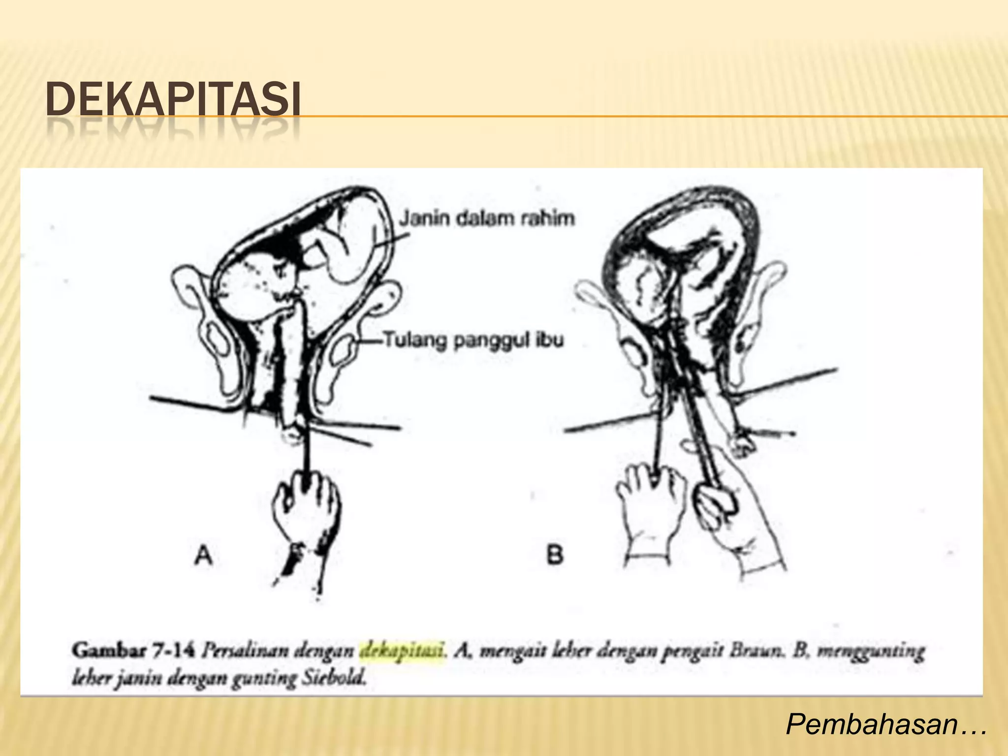 DEKAPITASI
Pembahasan…
 