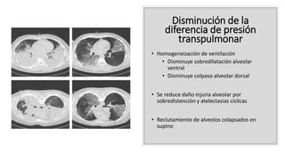 Disminución de la
diferencia de presión
transpulmonar
• Homogeneización de ventilación
• Disminuye sobredilatación alveolar
ventral
• Disminuye colpaso alveolar dorsal
• Se reduce daño injuria alveolar por
sobredistención y atelectasias cíclicas
• Reclutamiento de alveolos colapsados en
supino
 