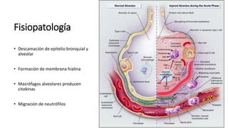 Fisiopatología
• Descamación de epitelio bronquial y
alveolar
• Formación de membrana hialina
• Macrófagos alveolares producen
citokinas
• Migración de neutrófilos
 