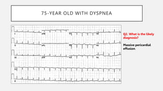 75-YEAR OLD WITH DYSPNEA
Q2. What is the likely
diagnosis?
Massive pericardial
effusion.
 