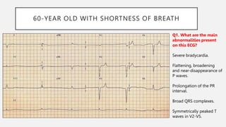 60-YEAR OLD WITH SHORTNESS OF BREATH
Q1. What are the main
abnormalities present
on this ECG?
Severe bradycardia.
Flattening, broadening
and near-disappearance of
P waves.
Prolongation of the PR
interval.
Broad QRS complexes.
Symmetrically peaked T
waves in V2-V5.
 