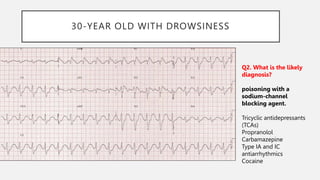 30-YEAR OLD WITH DROWSINESS
Q2. What is the likely
diagnosis?
poisoning with a
sodium-channel
blocking agent.
Tricyclic antidepressants
(TCAs)
Propranolol
Carbamazepine
Type IA and IC
antiarrhythmics
Cocaine
 