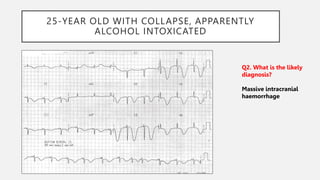 25-YEAR OLD WITH COLLAPSE, APPARENTLY
ALCOHOL INTOXICATED
Q2. What is the likely
diagnosis?
Massive intracranial
haemorrhage
 