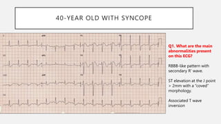 40-YEAR OLD WITH SYNCOPE
Q1. What are the main
abnormalities present
on this ECG?
RBBB-like pattern with
secondary R’ wave.
ST elevation at the J point
> 2mm with a “coved”
morphology.
Associated T wave
inversion
 