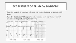 ECG FEATURES OF BRUGADA SYNDROME
• Type 1 = “Coved” ST elevation > 2mm at the J-point, followed by an inverted T
wave
• Type 2 = “Saddleback” ST segments with > 2mm J-point elevation, > 1mm ST
elevation and a positive or biphasic T wave
• Type 3 = Coved or saddleback ST elevation < 1mm
 