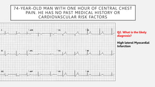 74-YEAR-OLD MAN WITH ONE HOUR OF CENTRAL CHEST
PAIN. HE HAS NO PAST MEDICAL HISTORY OR
CARDIOVASCULAR RISK FACTORS
Q2. What is the likely
diagnosis?
High lateral Myocardial
Infarction
 