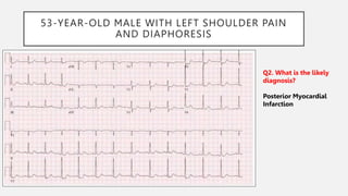 53-YEAR-OLD MALE WITH LEFT SHOULDER PAIN
AND DIAPHORESIS
Q2. What is the likely
diagnosis?
Posterior Myocardial
Infarction
 