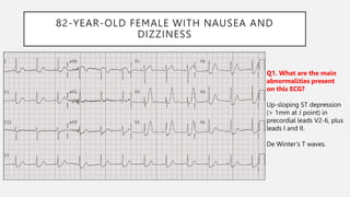 82-YEAR-OLD FEMALE WITH NAUSEA AND
DIZZINESS
Q1. What are the main
abnormalities present
on this ECG?
Up-sloping ST depression
(> 1mm at J point) in
precordial leads V2-6, plus
leads I and II.
De Winter’s T waves.
 