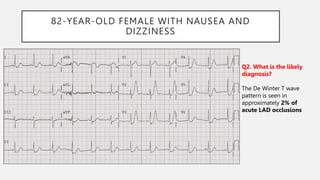82-YEAR-OLD FEMALE WITH NAUSEA AND
DIZZINESS
Q2. What is the likely
diagnosis?
The De Winter T wave
pattern is seen in
approximately 2% of
acute LAD occlusions
 