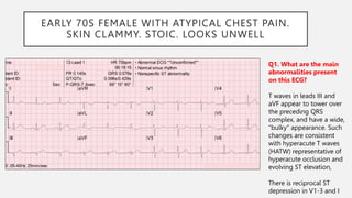EARLY 70S FEMALE WITH ATYPICAL CHEST PAIN.
SKIN CLAMMY. STOIC. LOOKS UNWELL
Q1. What are the main
abnormalities present
on this ECG?
T waves in leads III and
aVF appear to tower over
the preceding QRS
complex, and have a wide,
“bulky” appearance. Such
changes are consistent
with hyperacute T waves
(HATW) representative of
hyperacute occlusion and
evolving ST elevation,
There is reciprocal ST
depression in V1-3 and I
 