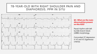 78-YEAR-OLD WITH RIGHT SHOULDER PAIN AND
DIAPHORESIS. PPM IN SITU
Q1. What are the main
abnormalities present
on this ECG?
Paced rhythm with left
bundle branch block
(LBBB) morphology.
Concordant ST depression
in V2 and V3 (Sgarbossa
criteria).
 