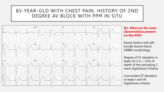 83-YEAR-OLD WITH CHEST PAIN. HISTORY OF 2ND
DEGREE AV BLOCK WITH PPM IN SITU
Q1. What are the main
abnormalities present
on this ECG?
Paced rhythm with left
bundle branch block
(LBBB) morphology.
Degree of ST elevation in
leads V2-5 is > 25% of
depth of the preceding S
wave (Sgarbossa Criteria).
Concordant ST elevation
in leads I and V6
(Sgarbossa criteria).
 