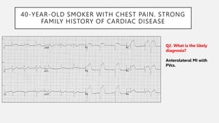40-YEAR-OLD SMOKER WITH CHEST PAIN. STRONG
FAMILY HISTORY OF CARDIAC DISEASE
Q2. What is the likely
diagnosis?
Anterolateral MI with
PVcs.
 
