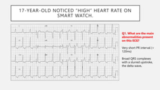17-YEAR-OLD NOTICED “HIGH” HEART RATE ON
SMART WATCH.
Q1. What are the main
abnormalities present
on this ECG?
Very short PR interval (<
120ms)
Broad QRS complexes
with a slurred upstroke,
the delta wave.
 