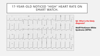 17-YEAR-OLD NOTICED “HIGH” HEART RATE ON
SMART WATCH.
Q2. What is the likely
diagnosis?
Wolff-Parkinson-White
Syndrome (WPW)
 